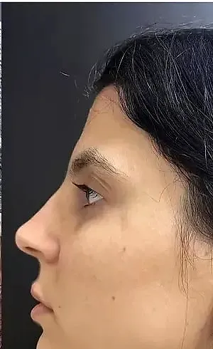 Preenchimento de mento, depois