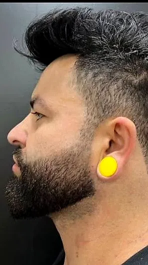 Rinomodelação com ácido hialurônico, antes