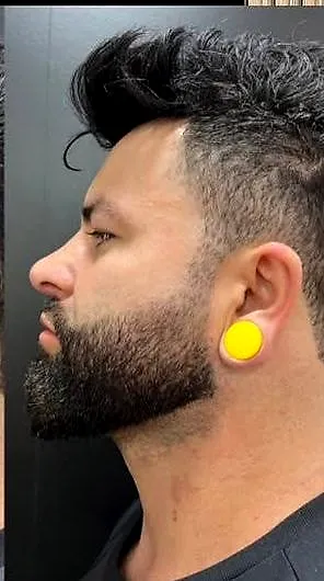 Rinomodelação com ácido hialurônico, depois
